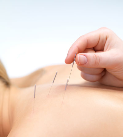 acupuncture treatment